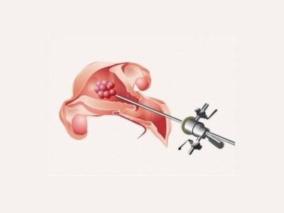 Histerorezektoskopiya nədir?