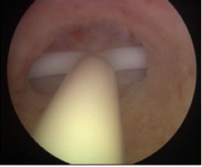 Uşaqlıqdaxili spiralın xaric edilməsi