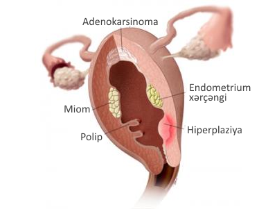 Uşaqlıqdaxili patologiyaların müasir diaqnostika və müalicəsi